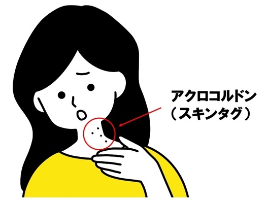 アクロコルドン - コピー